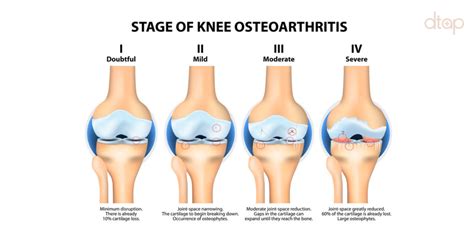 icd 10 knee osteoarthritis